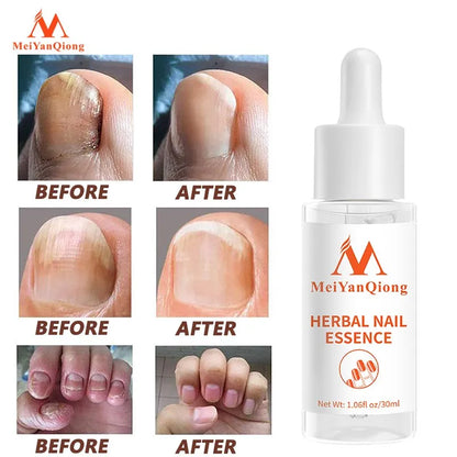 Serum de Cuidado de Uñas MeiYanQiong: Restaura, Trata y Fortalece 🌿🌟💅