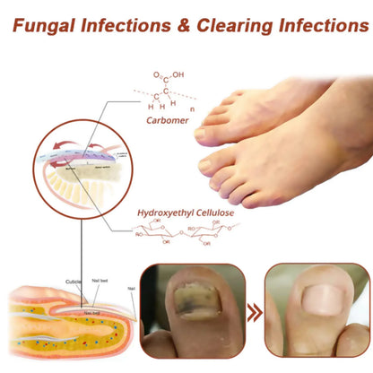 ¡Tratamiento láser para hongos en las uñas de MOKARLE - Uñas sanas y bonitas en casa!